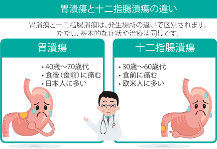 胃潰瘍と十二指腸潰瘍の疑い