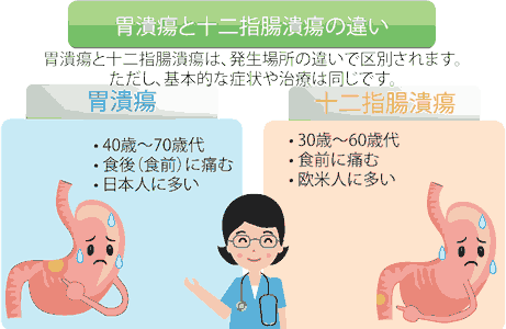 胃潰瘍と十二指腸潰瘍の違いは発生場所等で区別されます