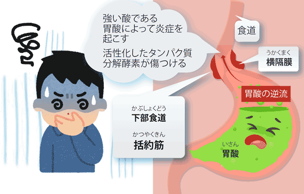 逆流性食道炎は強い酸によって炎症を起こす